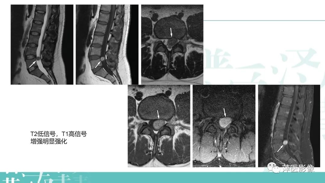 【PPT】髓外硬膜内肿瘤-17