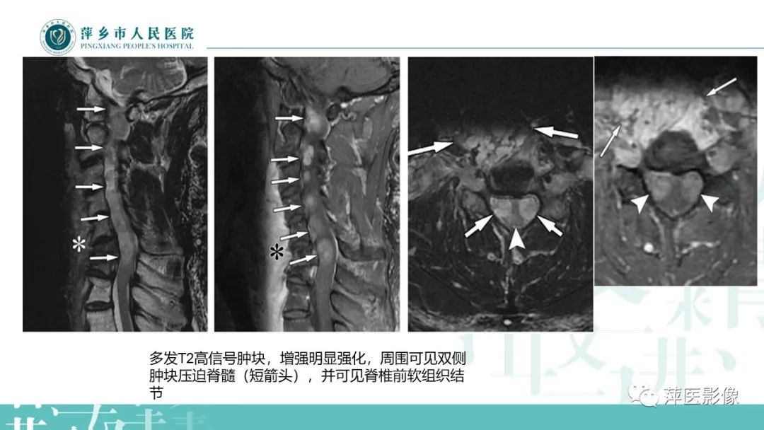 【PPT】髓外硬膜内肿瘤-19