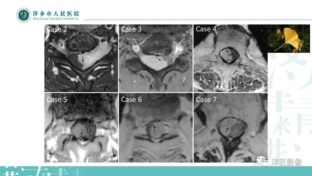 【PPT】髓外硬膜内肿瘤-12