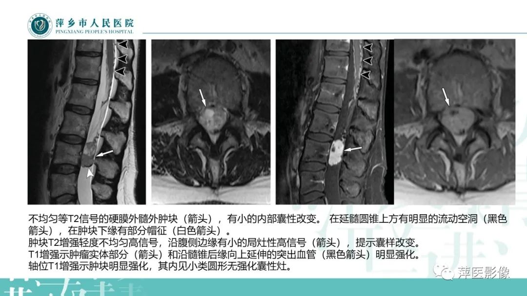 【PPT】髓外硬膜内肿瘤-23