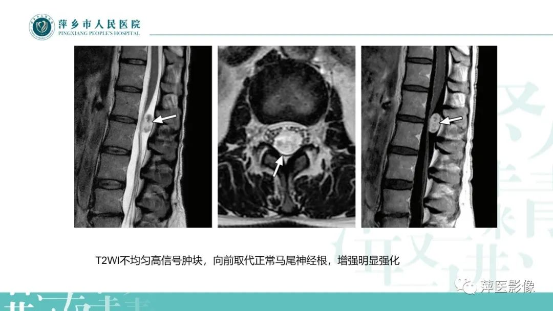 【PPT】髓外硬膜内肿瘤-21