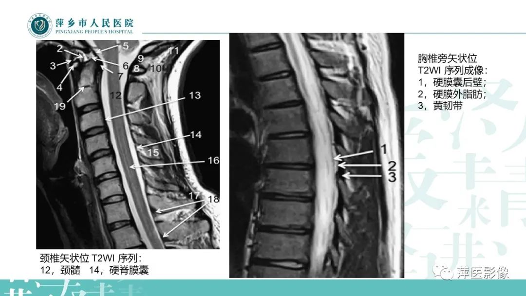 【PPT】髓外硬膜内肿瘤-5