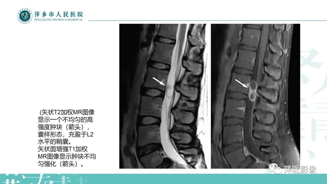 【PPT】髓外硬膜内肿瘤-14