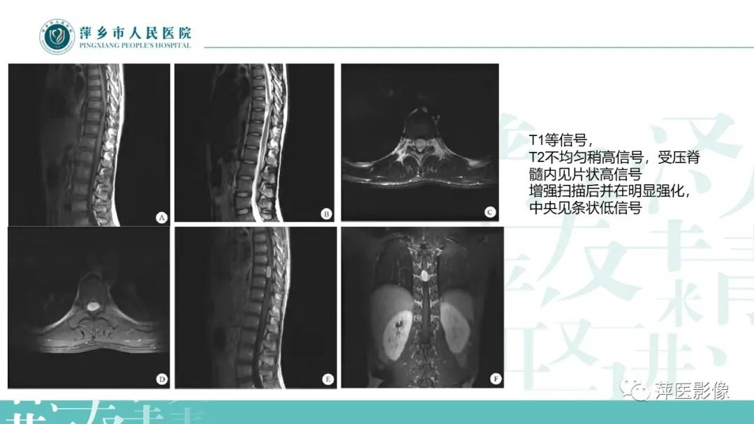 【PPT】髓外硬膜内肿瘤-15