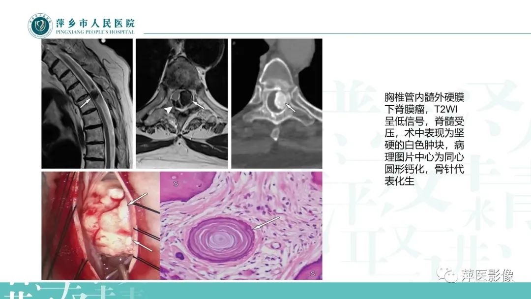 【PPT】髓外硬膜内肿瘤-11