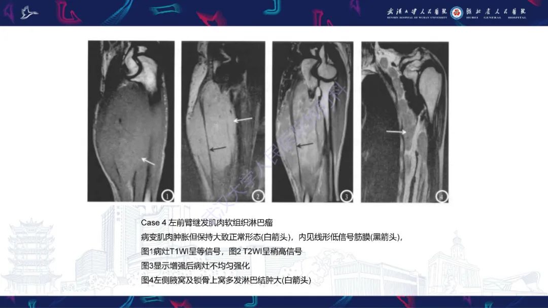 【PPT】软组织淋巴瘤影像诊断-15