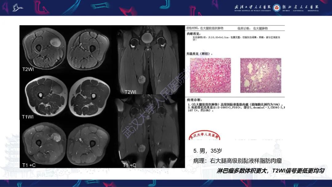 【PPT】软组织淋巴瘤影像诊断-22