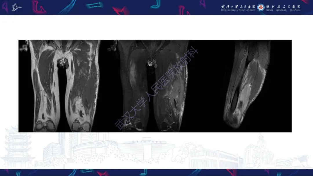 【PPT】软组织淋巴瘤影像诊断-3