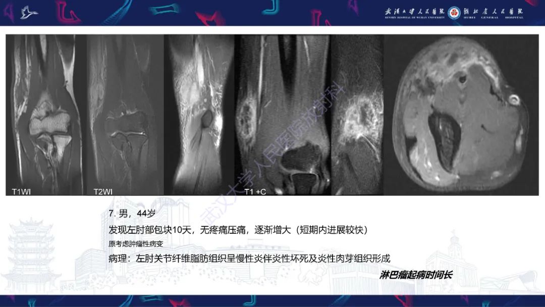 【PPT】软组织淋巴瘤影像诊断-24