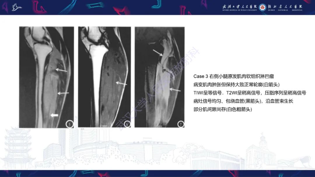 【PPT】软组织淋巴瘤影像诊断-14