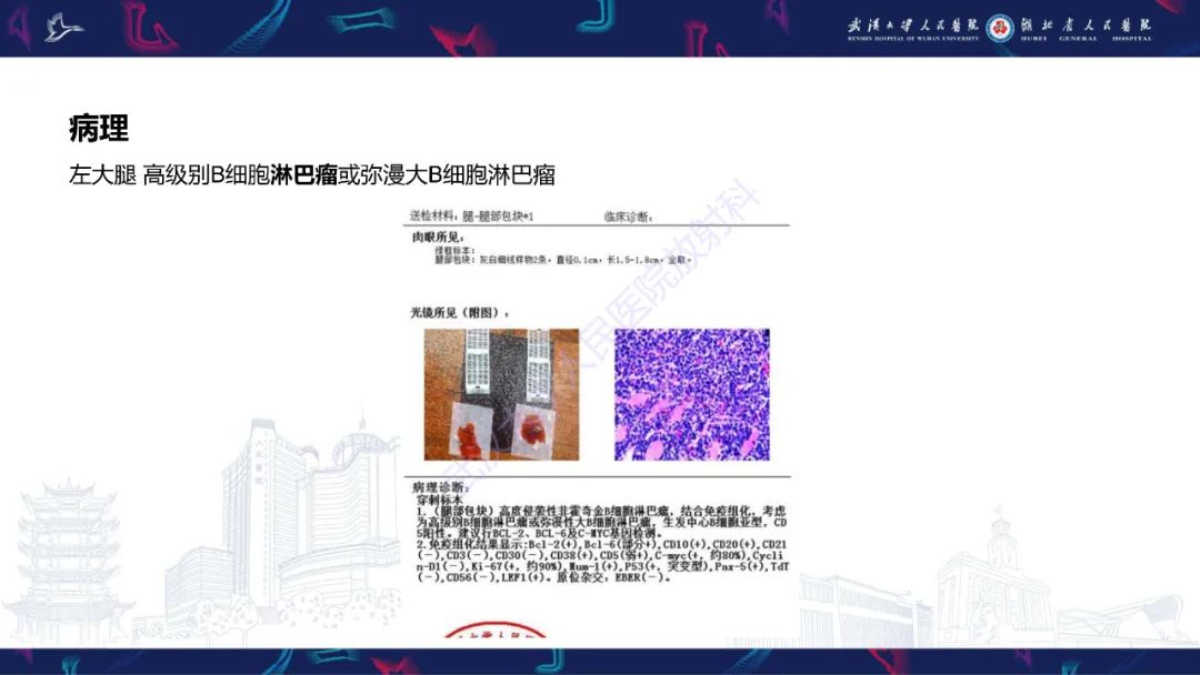 【PPT】软组织淋巴瘤影像诊断-4