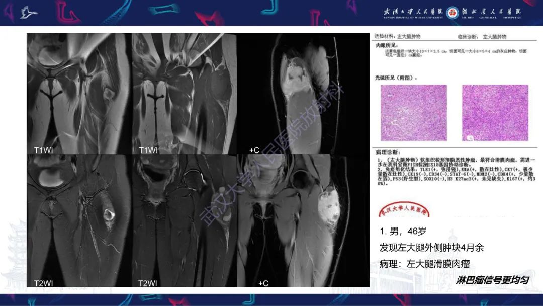 【PPT】软组织淋巴瘤影像诊断-18