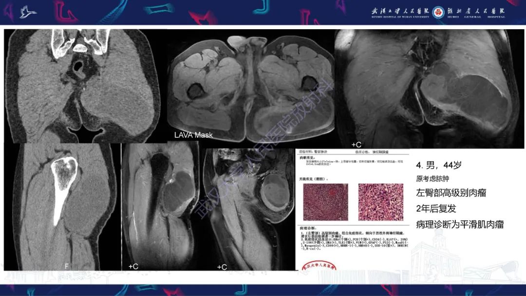 【PPT】软组织淋巴瘤影像诊断-21