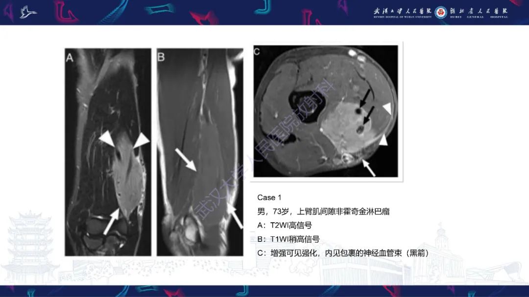 【PPT】软组织淋巴瘤影像诊断-12