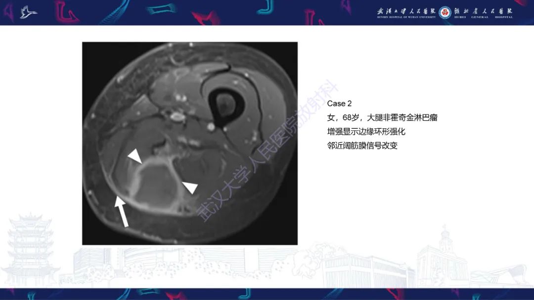 【PPT】软组织淋巴瘤影像诊断-13