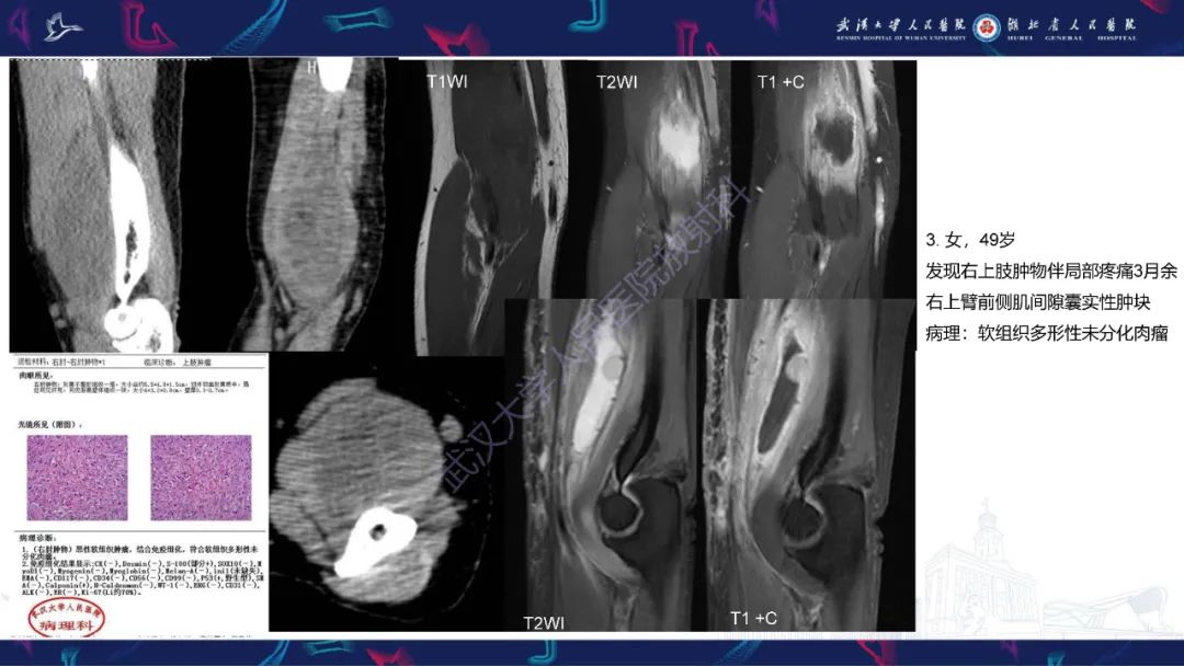 【PPT】软组织淋巴瘤影像诊断-20