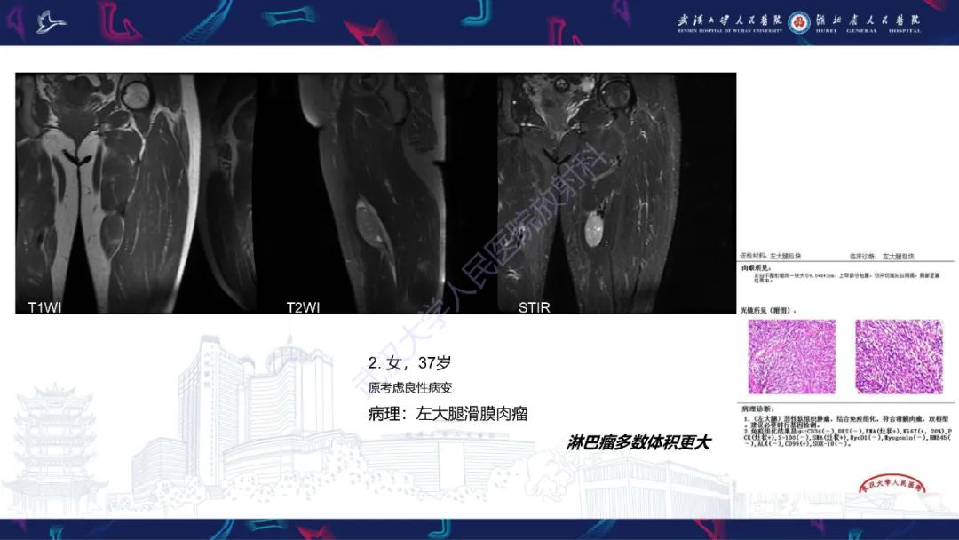 【PPT】软组织淋巴瘤影像诊断-19