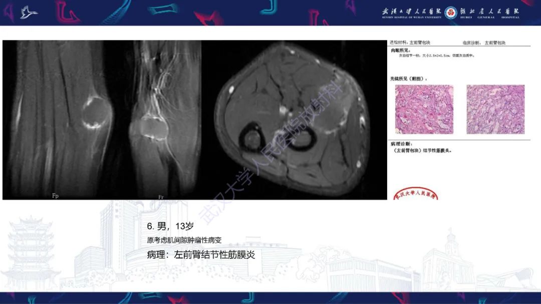 【PPT】软组织淋巴瘤影像诊断-23