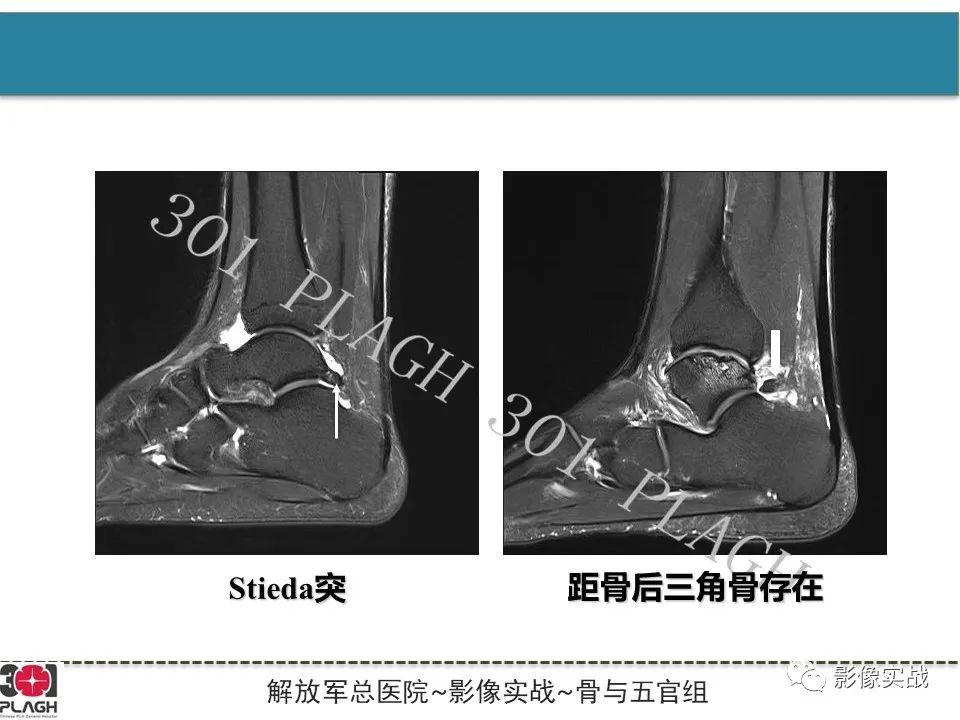 【病例】后踝撞击综合征1例MR影像-9