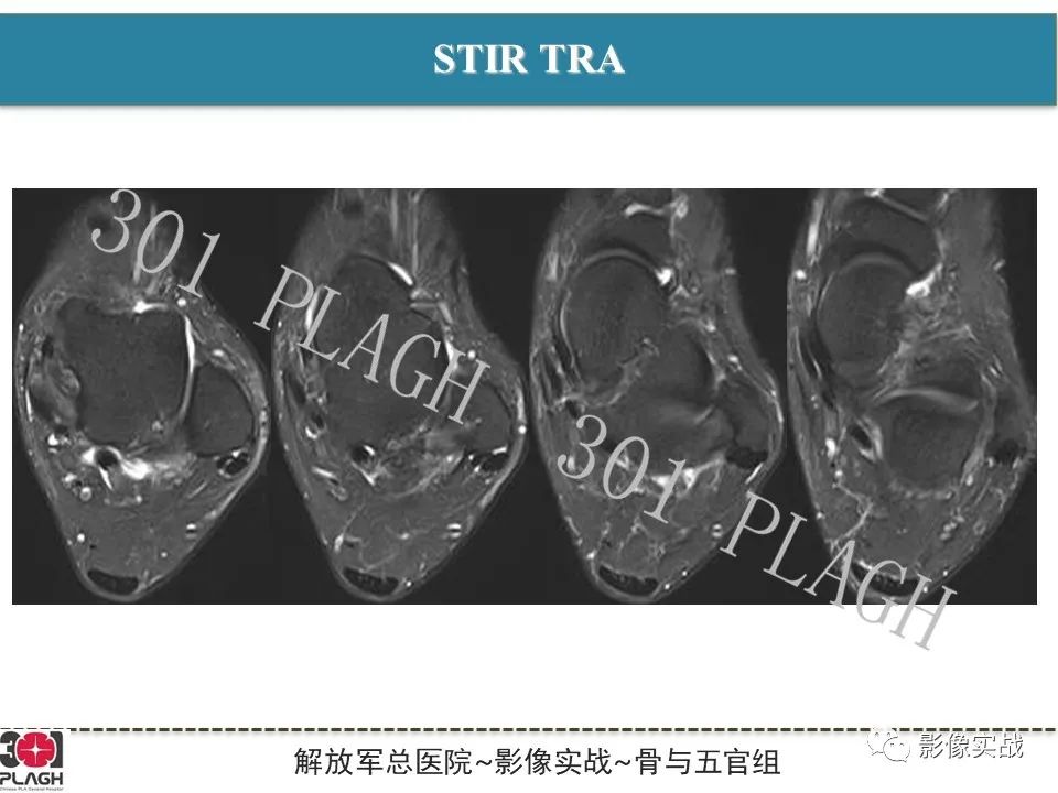 【病例】后踝撞击综合征1例MR影像-5