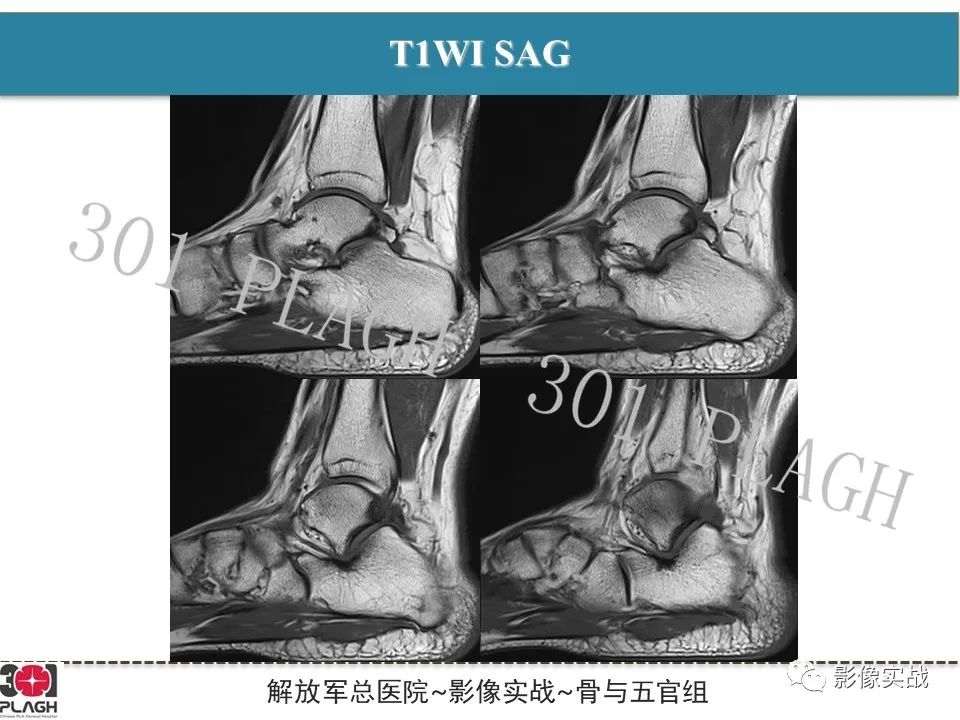【病例】后踝撞击综合征1例MR影像-3