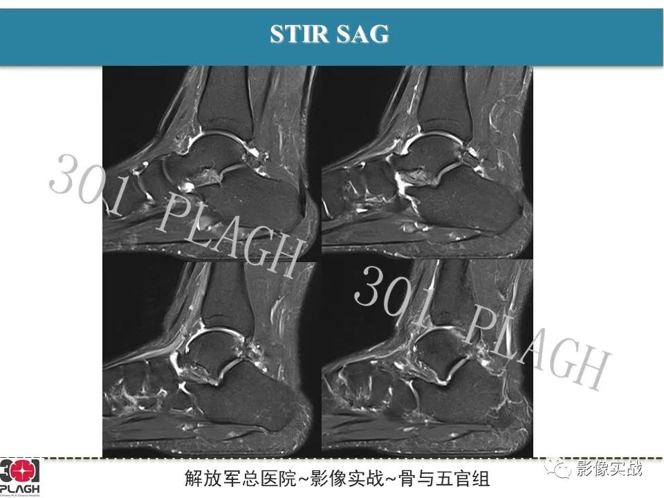 【病例】后踝撞击综合征1例MR影像-4