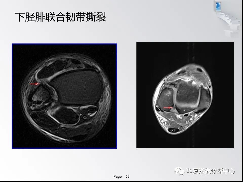【PPT】踝关节韧带损伤MR表现与损伤机制分析-38 【PPT】踝关节韧带损伤MR表现与损伤机制分析-38
