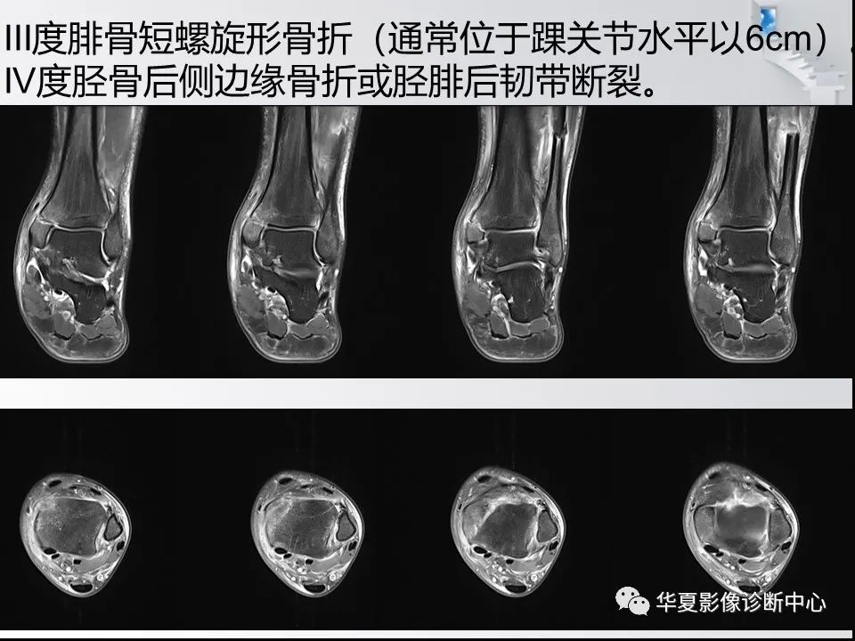 【PPT】踝关节韧带损伤MR表现与损伤机制分析-46 【PPT】踝关节韧带损伤MR表现与损伤机制分析-46