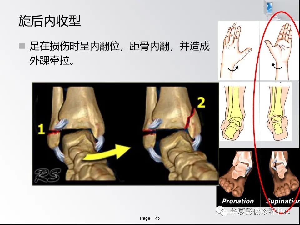 【PPT】踝关节韧带损伤MR表现与损伤机制分析-47 【PPT】踝关节韧带损伤MR表现与损伤机制分析-47