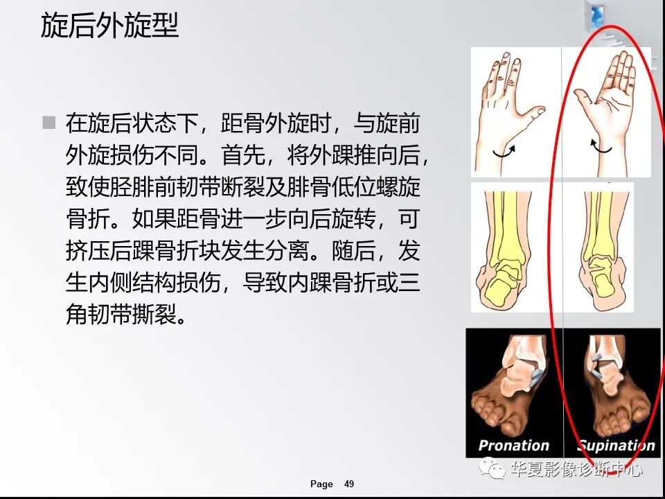 【PPT】踝关节韧带损伤MR表现与损伤机制分析-51 【PPT】踝关节韧带损伤MR表现与损伤机制分析-51