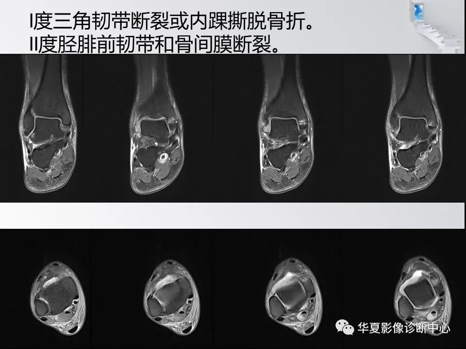 【PPT】踝关节韧带损伤MR表现与损伤机制分析-45 【PPT】踝关节韧带损伤MR表现与损伤机制分析-45