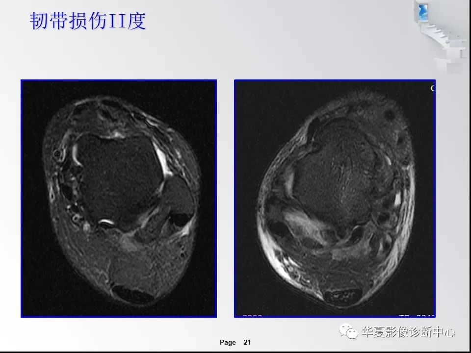 【PPT】踝关节韧带损伤MR表现与损伤机制分析-23 【PPT】踝关节韧带损伤MR表现与损伤机制分析-23