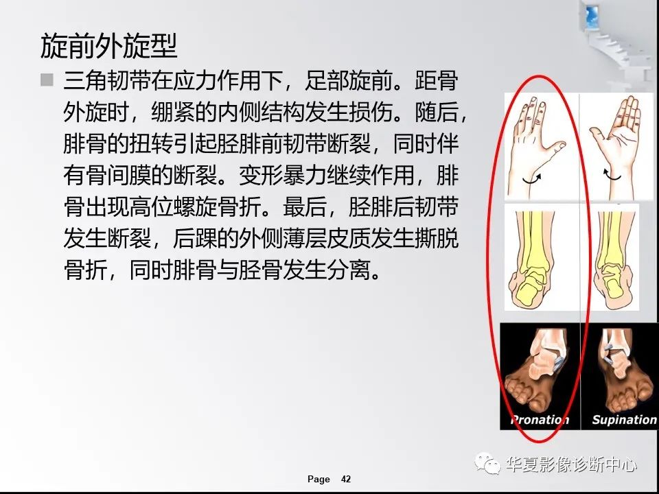 【PPT】踝关节韧带损伤MR表现与损伤机制分析-44 【PPT】踝关节韧带损伤MR表现与损伤机制分析-44