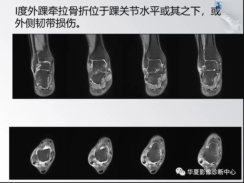 【PPT】踝关节韧带损伤MR表现与损伤机制分析-48 【PPT】踝关节韧带损伤MR表现与损伤机制分析-48