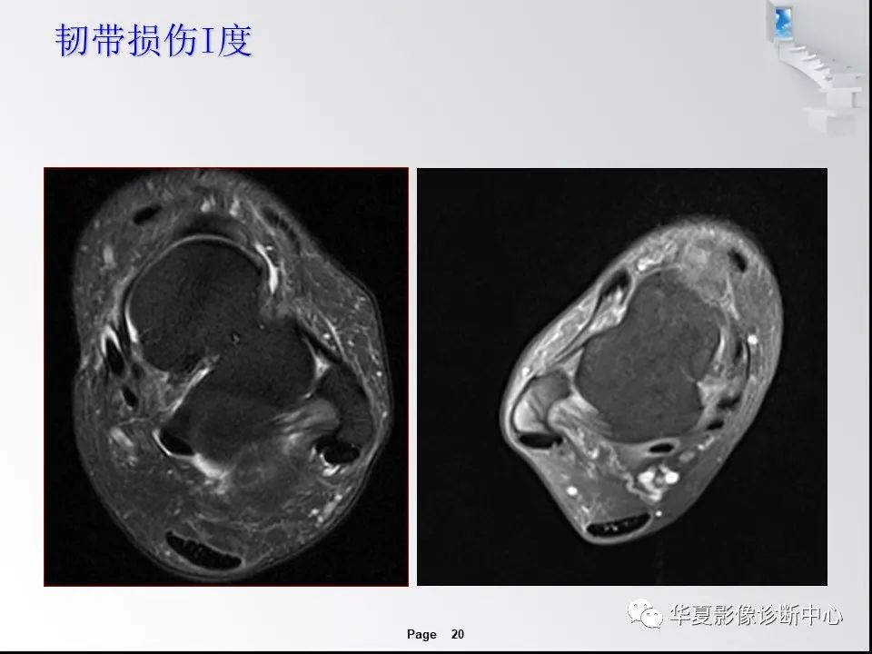 【PPT】踝关节韧带损伤MR表现与损伤机制分析-22 【PPT】踝关节韧带损伤MR表现与损伤机制分析-22