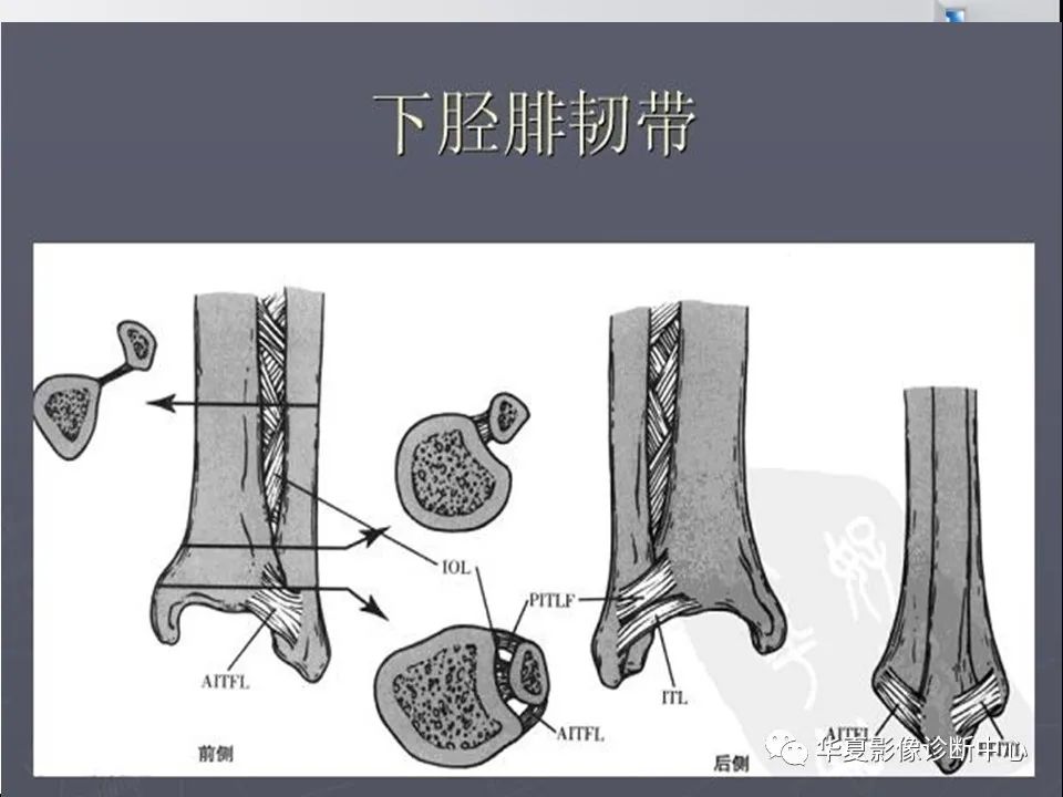 【PPT】踝关节韧带损伤MR表现与损伤机制分析-16 【PPT】踝关节韧带损伤MR表现与损伤机制分析-16