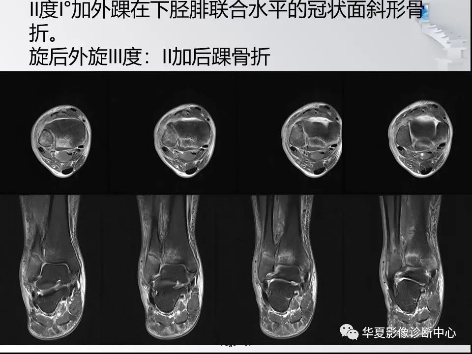 【PPT】踝关节韧带损伤MR表现与损伤机制分析-53 【PPT】踝关节韧带损伤MR表现与损伤机制分析-53