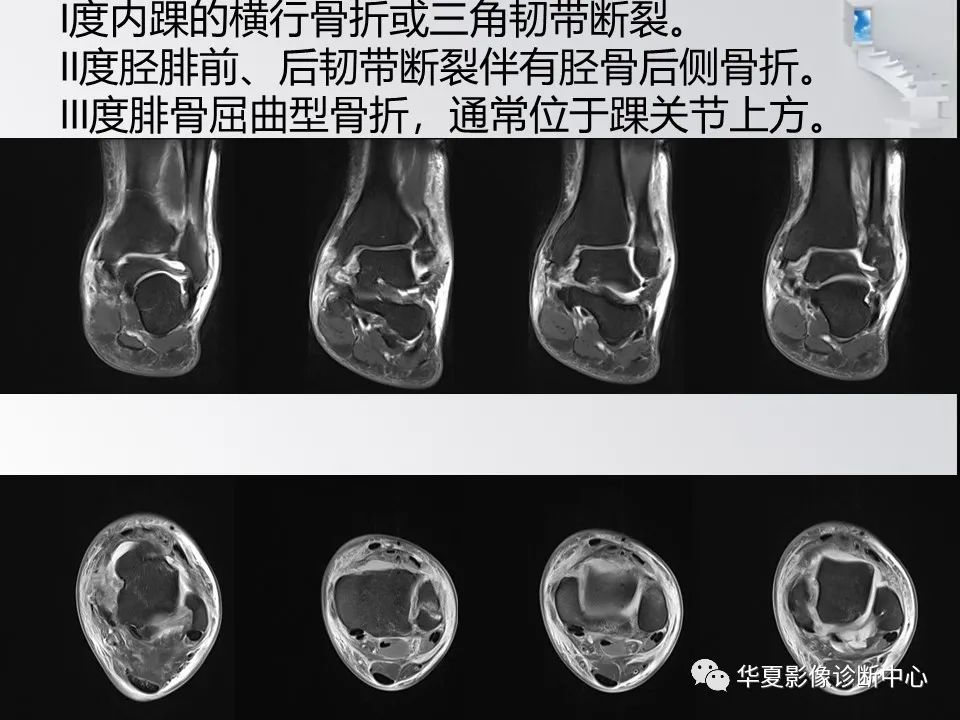 【PPT】踝关节韧带损伤MR表现与损伤机制分析-43 【PPT】踝关节韧带损伤MR表现与损伤机制分析-43