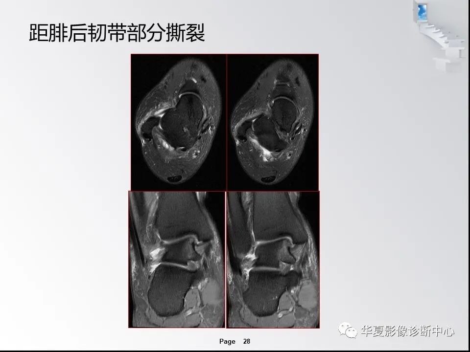 【PPT】踝关节韧带损伤MR表现与损伤机制分析-30 【PPT】踝关节韧带损伤MR表现与损伤机制分析-30