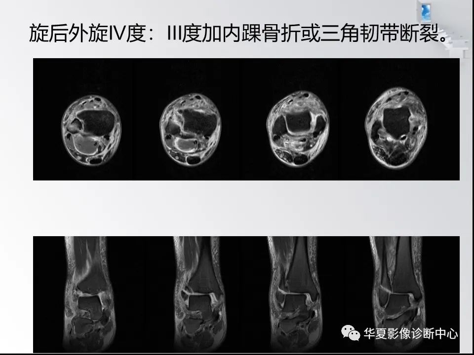 【PPT】踝关节韧带损伤MR表现与损伤机制分析-54 【PPT】踝关节韧带损伤MR表现与损伤机制分析-54