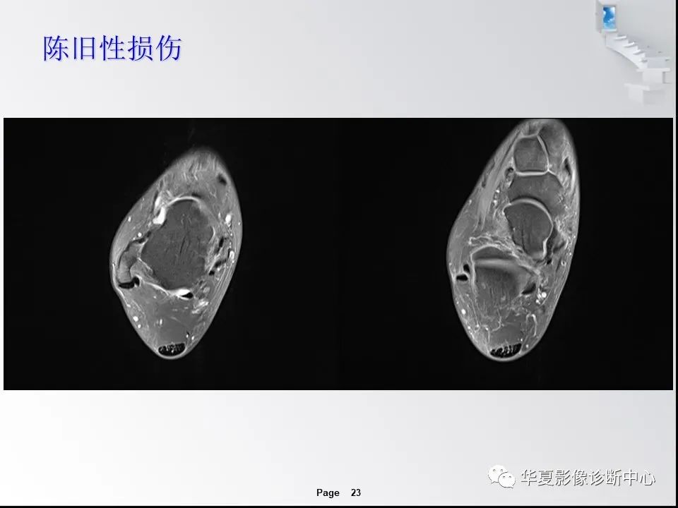 【PPT】踝关节韧带损伤MR表现与损伤机制分析-25 【PPT】踝关节韧带损伤MR表现与损伤机制分析-25