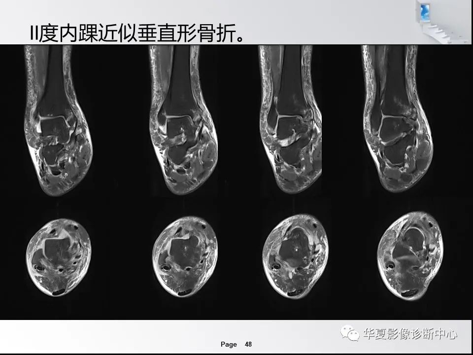 【PPT】踝关节韧带损伤MR表现与损伤机制分析-50 【PPT】踝关节韧带损伤MR表现与损伤机制分析-50