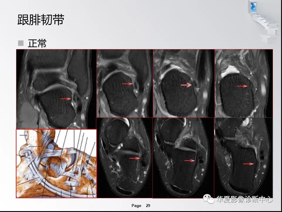 【PPT】踝关节韧带损伤MR表现与损伤机制分析-31 【PPT】踝关节韧带损伤MR表现与损伤机制分析-31