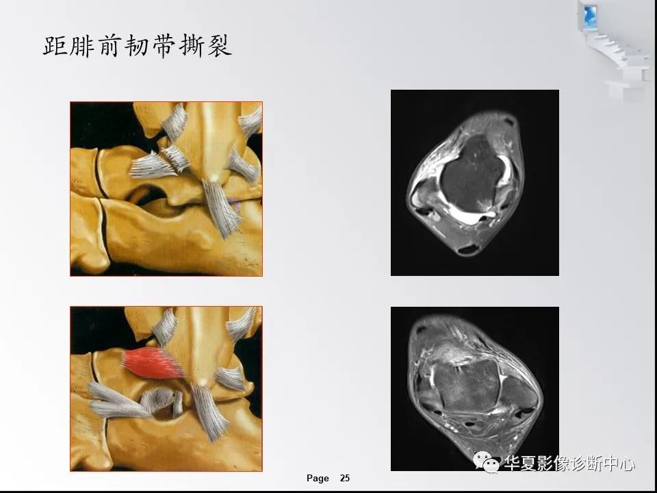 【PPT】踝关节韧带损伤MR表现与损伤机制分析-27 【PPT】踝关节韧带损伤MR表现与损伤机制分析-27