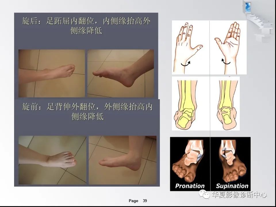 【PPT】踝关节韧带损伤MR表现与损伤机制分析-41 【PPT】踝关节韧带损伤MR表现与损伤机制分析-41