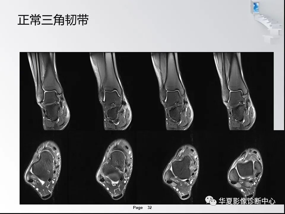 【PPT】踝关节韧带损伤MR表现与损伤机制分析-34 【PPT】踝关节韧带损伤MR表现与损伤机制分析-34