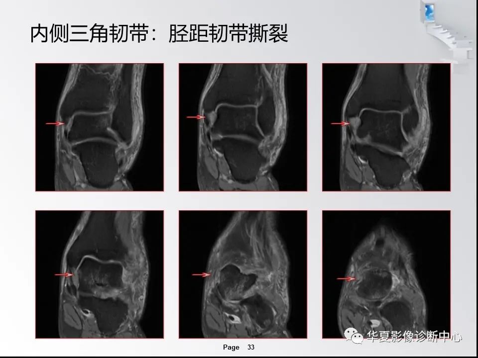 【PPT】踝关节韧带损伤MR表现与损伤机制分析-35 【PPT】踝关节韧带损伤MR表现与损伤机制分析-35
