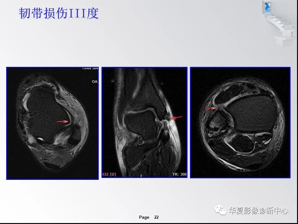 【PPT】踝关节韧带损伤MR表现与损伤机制分析-24 【PPT】踝关节韧带损伤MR表现与损伤机制分析-24