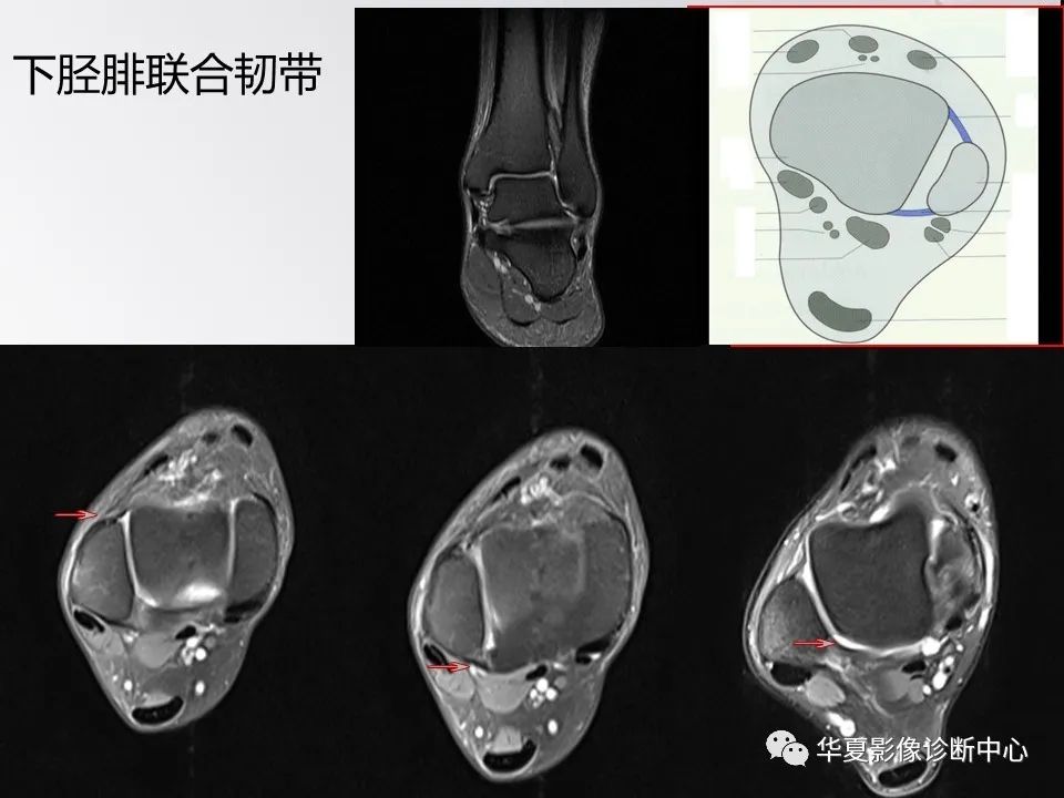 【PPT】踝关节韧带损伤MR表现与损伤机制分析-37 【PPT】踝关节韧带损伤MR表现与损伤机制分析-37