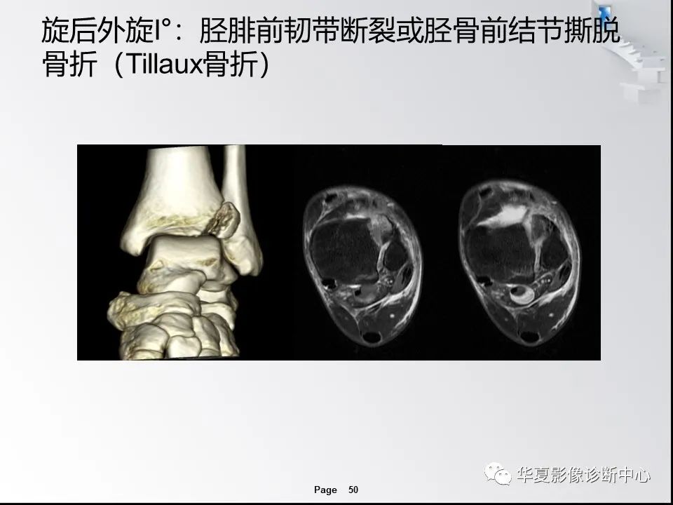 【PPT】踝关节韧带损伤MR表现与损伤机制分析-52 【PPT】踝关节韧带损伤MR表现与损伤机制分析-52